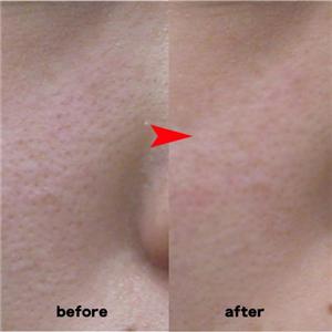 GLABAS�@���n�N���[��