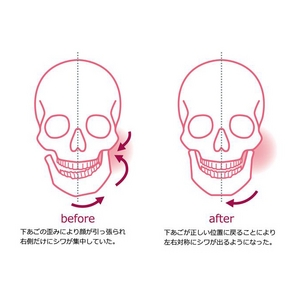 頭蓋骨自己矯正エクササイズ スカルコントロールDVD+骨格矯正用マウスピース