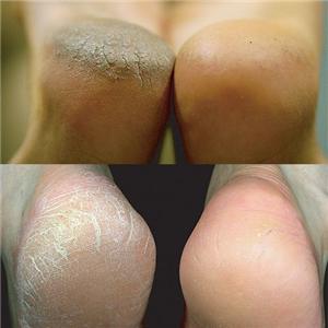Pedix��Foot Peel