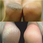 Pedix��Foot Peel
