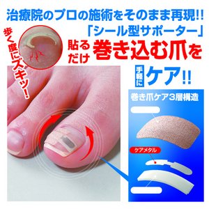 巻き爪シール（2ヶ月ケア）